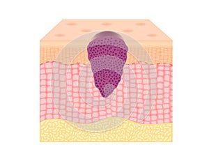 Skin cancer cells in a growing tumor vector