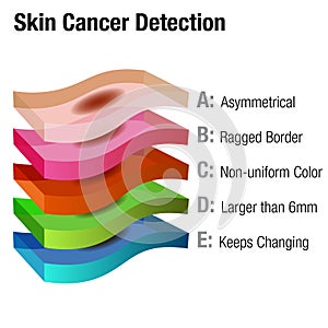 Skin Cancer Detection photo
