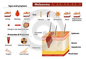 Kůže rakovina infografiky 