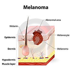Skin cancer. Melanoma photo
