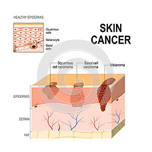 Skin cancer. Squamous cell carcinoma, basal-cell cancer and Melanoma.