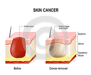 Skin cancer photo