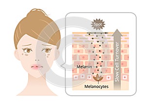 skin cell turnover and dark spots on young womanâ€™s face. melanin and melanocytes in human skin layer. Beauty and skin care