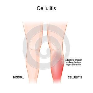 Skin cellulitis. Healthy leg, and leg with symptoms of Infectious disease