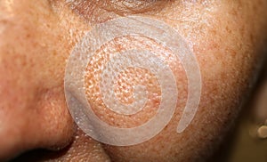 Skin on cheek with enlarged pores. macro photo