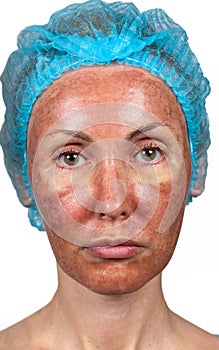 Skin condition after chemical peeling TCA. face photo