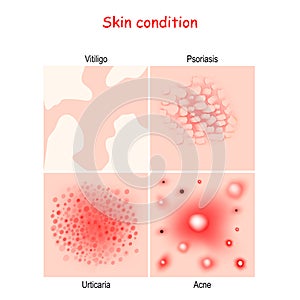 Skin condition and diseases. Close-up of Acne, Urticaria, Psoriasis, Vitiligo