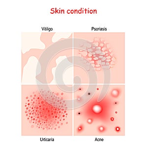Skin condition and diseases. Close-up of Acne, Urticaria, Psoriasis, Vitiligo photo