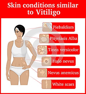 Skin conditions having an external resemblance to Vitiligo