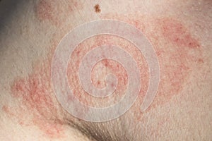 Skin dermatitis photo