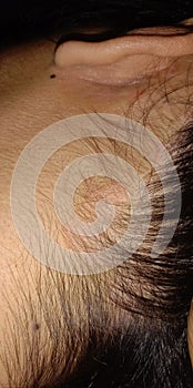 Skin Deseases On the head