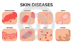 Skin disease. Different diseases, epidermis surface with eczema. Dermatology, allergy symptoms. Human body psoriasis photo