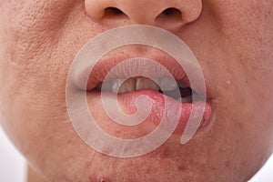 Skin disease problem , Dry and chapped lip from lip biting, Acne scar and pimples with large pore.