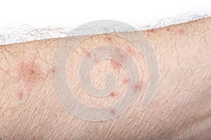 Skin disease rash on a man arm