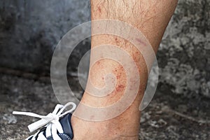 Skin disease winter. Healthcare dry cracking skin and rash red of leg on during weather cold. Dermatologist and treatment