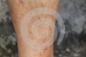 Skin disease winter. Healthcare dry cracking skin and rash red of leg on during weather cold. Dermatologist and treatment