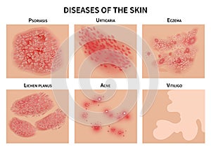 Skin diseases. Derma infection, eczema and psoriasis. Dermatology vector illustration photo