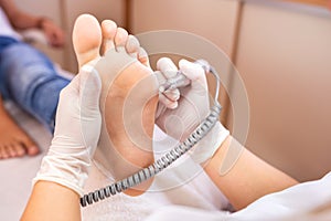 Skin filing of the lateral sole foot area