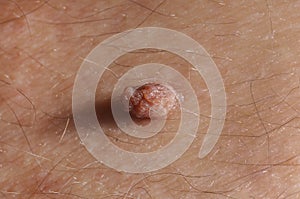 Nevus photo