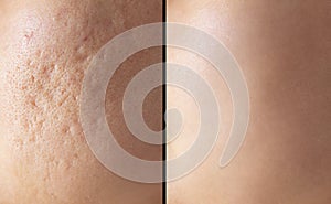 Skin human texture background. Closeup before and after spot red scar acne pimple treatment on skin face asian woman.