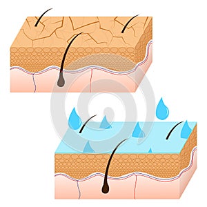 Skin hydration and dry skin sectional view.