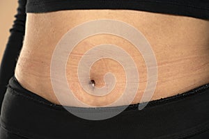 Skin indents from underwear on a woman`s belly