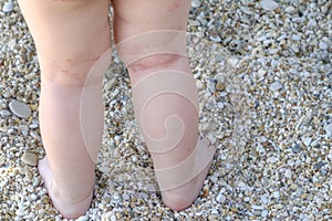 Skin irritation newborn atopic dermatitis legs photo