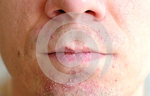 Skin irritation after shaving on man`s skin. Closeup nose and lips.