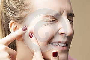 Skin Issues. Portrait of Young Emotional  Caucasian Blond Woman With Skin Problems Squeezing Pustules By Fingers Against Beige