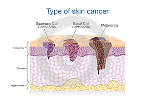 Skin layer have 3 Type of Cancer in one.