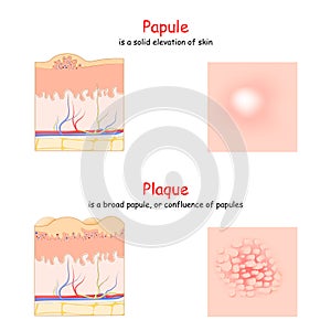 Skin lesion. Papule and Plaque. side and top view. Cross section of the human skin