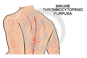 The skin lesions in immune thrombocytopenic purpura