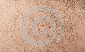 Skin mole closeup. Macro photo of blemish similar to melanoma