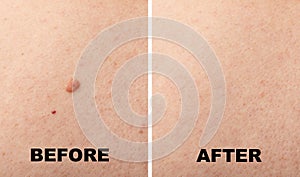 Skin mole closeup. Macro photo of blemish similar to melanoma photo