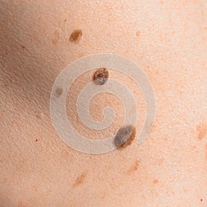 Skin mole on human body. Brown nevi or nevus on back skin. Check moles concept. Closeup