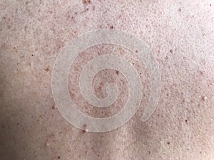 Skin with moles. Health and beauty background