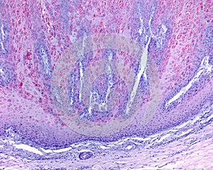 Skin. Molluscum contagiosum photo