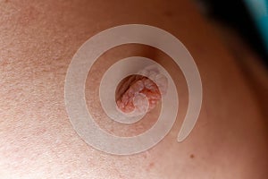 Skin nodule on a buttock