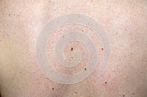 Skin om chest of person with moles and freckles