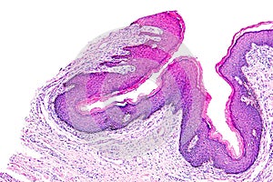 Skin papilloma of a human