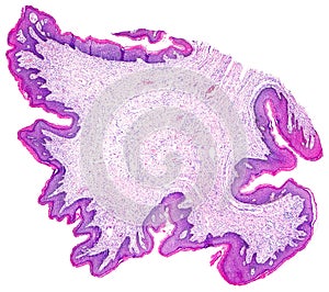 Skin papilloma of a human photo