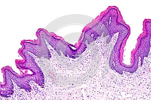 Skin papilloma of a human
