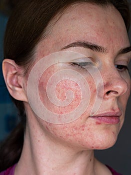 The skin of a patient with papulopustular rosacea