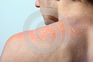 Skin peeling after sunburn