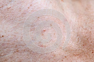 Skin pigmentation. Moles and freckles