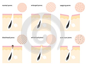 Skin pores