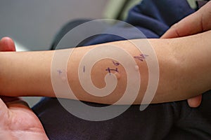 Skin Prick Allergy Test on a little child's arm, positive results