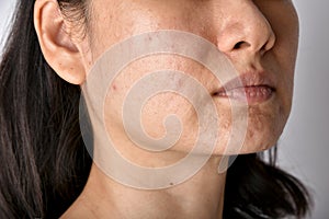 Skin problem with acne diseases, Close up of asian woman face with whitehead pimples, Menstruation breakout