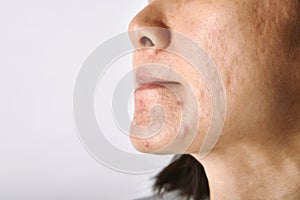 Skin problem with acne diseases, Close up of asian woman face with whitehead pimples, Menstruation breakout