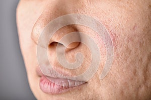 Skin problem with acne diseases, Close up woman face with acne marks and allergy red rash, Scar and oily greasy face